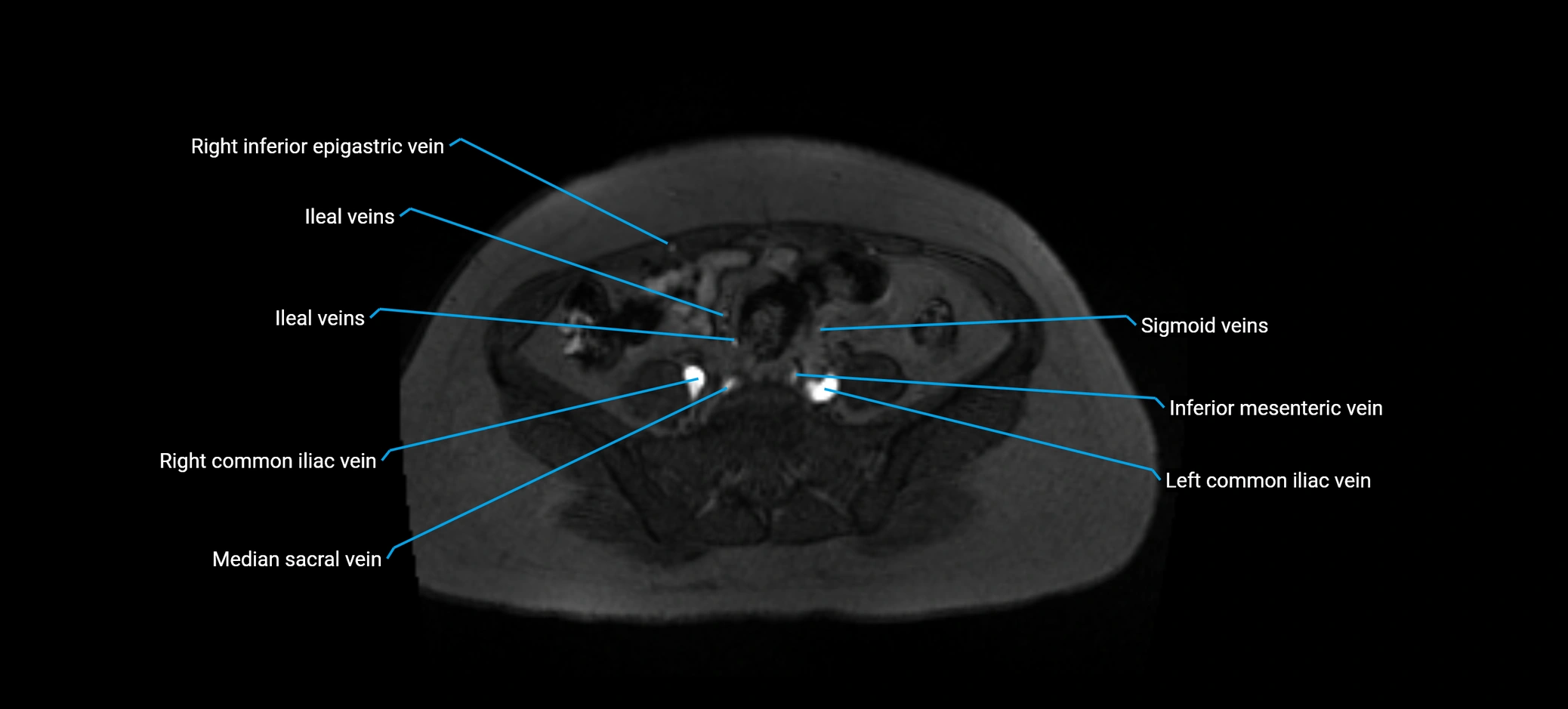 MRV abdomen pelvis & lower limb axial cross sectional anatomy labelled MRI image 131 (1).webp